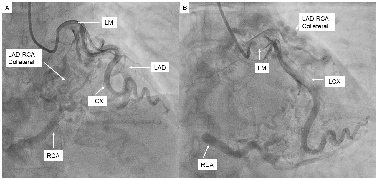 Figure 1. Selective left coronary angiography