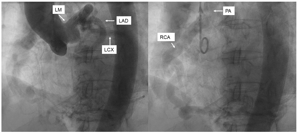 Figure 2. Ascending aortogram
