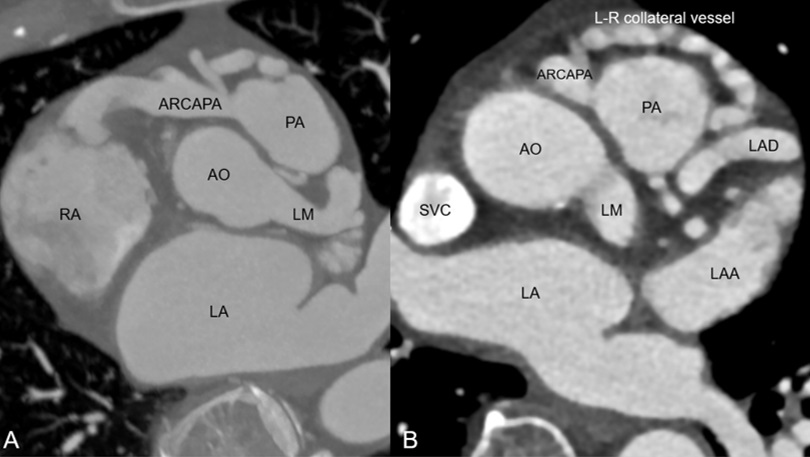 Figure 4. CT angiography of the heart. 