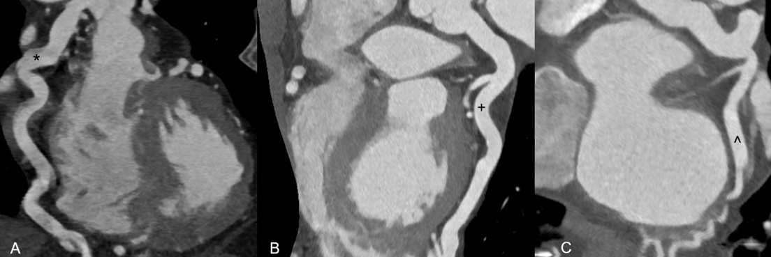 Figure 5. Multi-planar reconstructions of CT coronary angiography. 