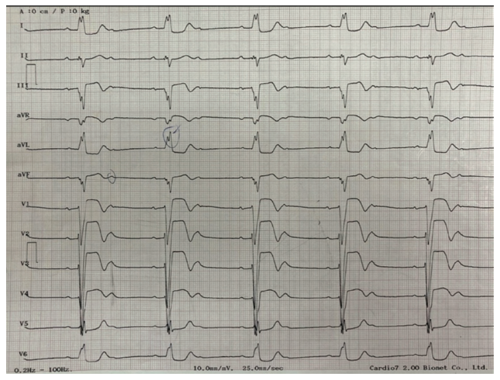 Guzman-Olea Pacemaker Figure 1