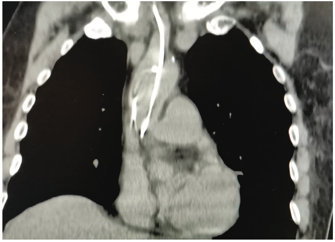 Guzman-Olea Pacemaker Figure 3