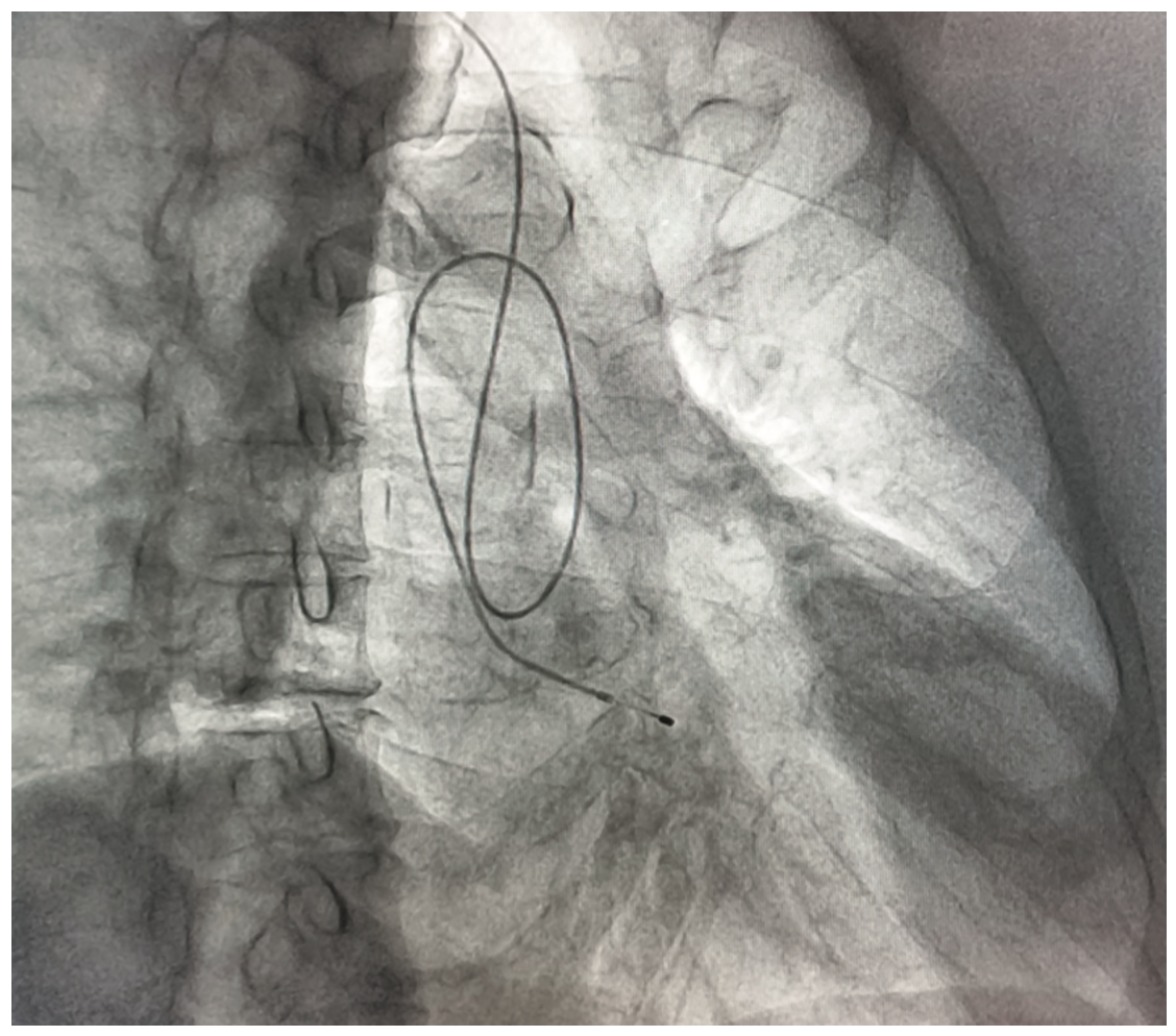 Guzman-Olea Pacemaker Figure 4