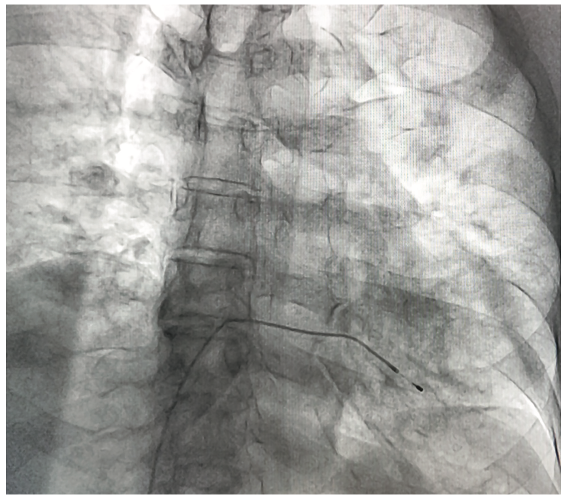 Guzman-Olea Pacemaker Figure 5