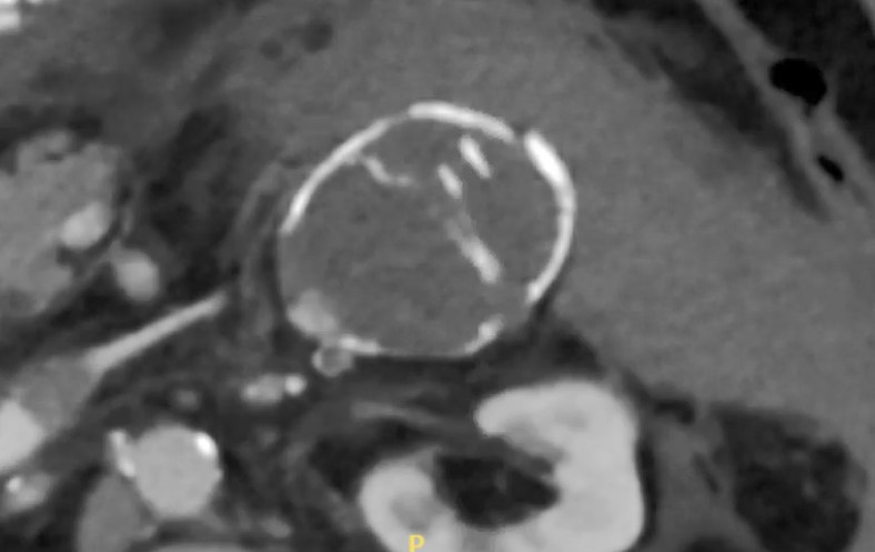 Figure 1. Computed tomography demonstrating a large, ruptured left renal artery aneurysm.