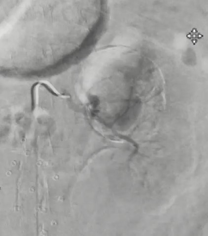 Figure 2. Selective left renal arteriogram showing active extravasation from a renal artery aneurysm.