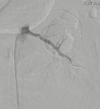 Figure 3. Selective left renal arteriogram demonstrating exclusion of a renal artery aneurysm with distal perfusion via a covered stent.