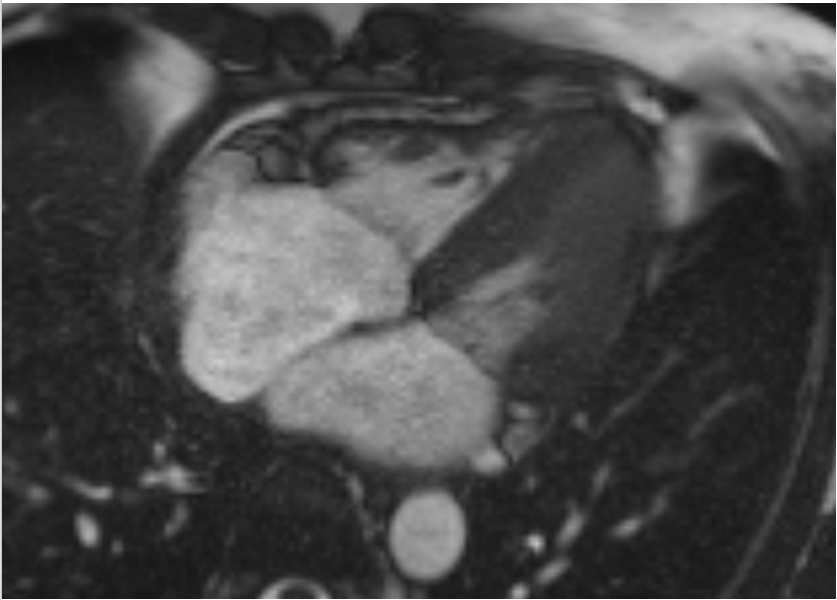 (Case 1) Figure 1. Cardiac MRI demonstrating pericardial thickening and edema consistent with active pericardial inflammation.