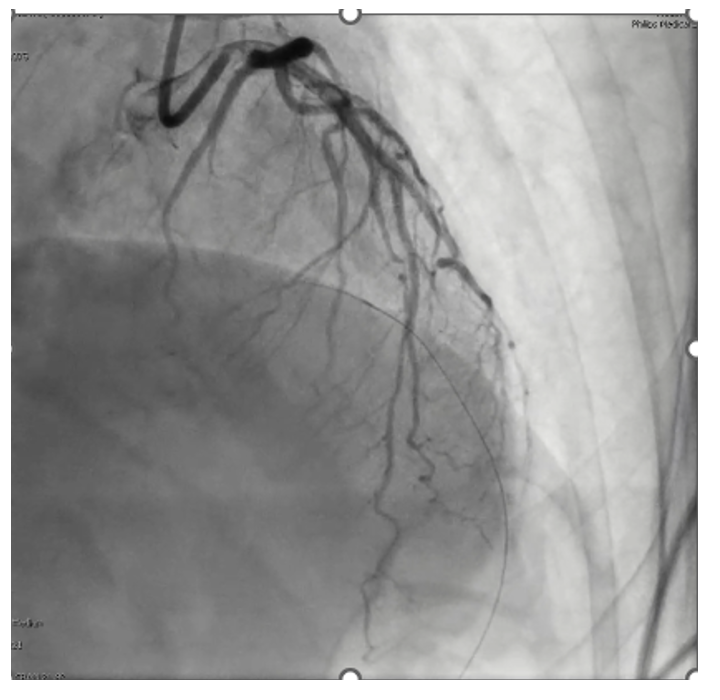 (Case 1) Figure 2. Acetylcholine provocative testing at 100 mcg demonstrating significant mid-left anterior descending (LAD) coronary artery vasospasm with associated chest pain and ischemic electrocardiogram changes.