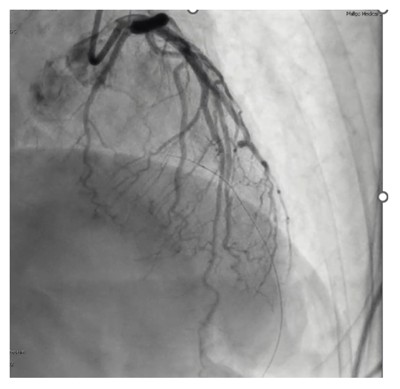 (Case 1) Figure 3. Resolution of mid-LAD vasospasm following intracoronary nitroglycerin administration with restoration of normal vessel caliber.