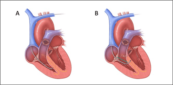 A new global consensus statement published in Heart Rhythm establishes a blueprint for holistic cardiac device implantable electronic (CIED) lead management and more tailored treatment options for patients. This image depicts the right ventricular lead positioning relative to the tricuspid valve. (A) Placement of leads on the right ventricular septum (versus apical pacing) has not been associated with worsening tricuspid regurgitation. (B) When implanting leads for left bundle branch area pacing, a shorter lead to tricuspid annulus distance can result in more tricuspid regurgitation. (Credit: Heart Rhythm / Cha et al.)