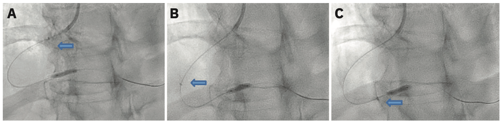 Heo Lithotripsy Figure 1
