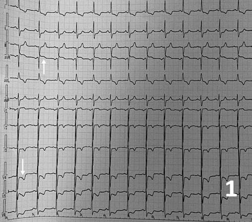 Figure 1.  Electrocardiogram 