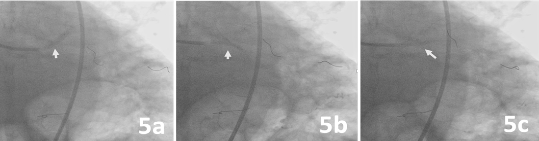 Figure 5. Predilatation of the left anterior descending artery