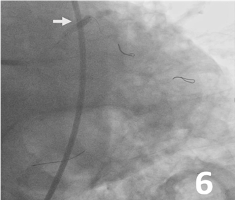 Figure 6. Stent implantation 