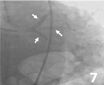 Figure 7. Simultaneous stent implantation