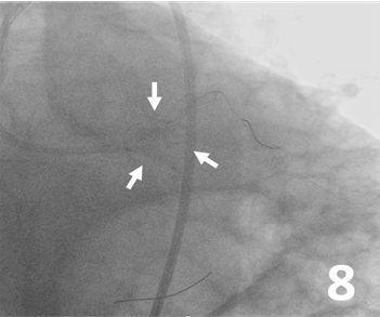 Figure 8. Simultaneous triple-balloon inflation 