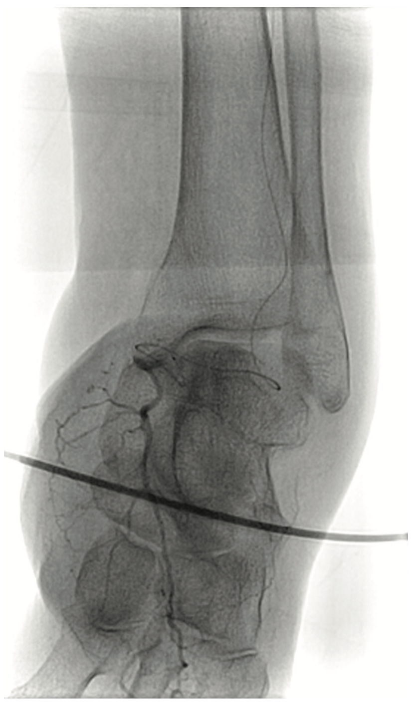 Heuser Fem-Pop Graft Failure Figure 10