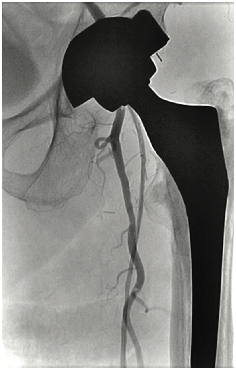 Heuser Fem-Pop Graft Failure Figure 11