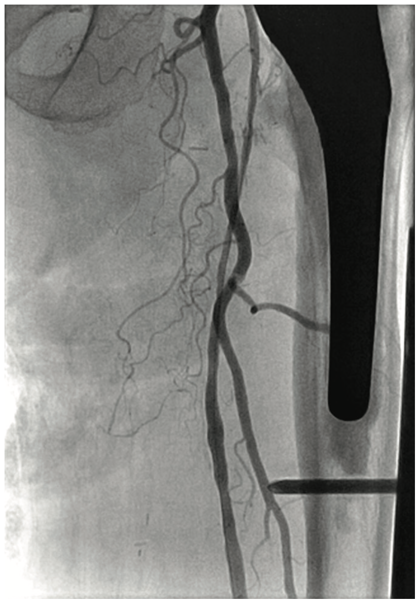 Heuser Fem-Pop Graft Failure Figure 12