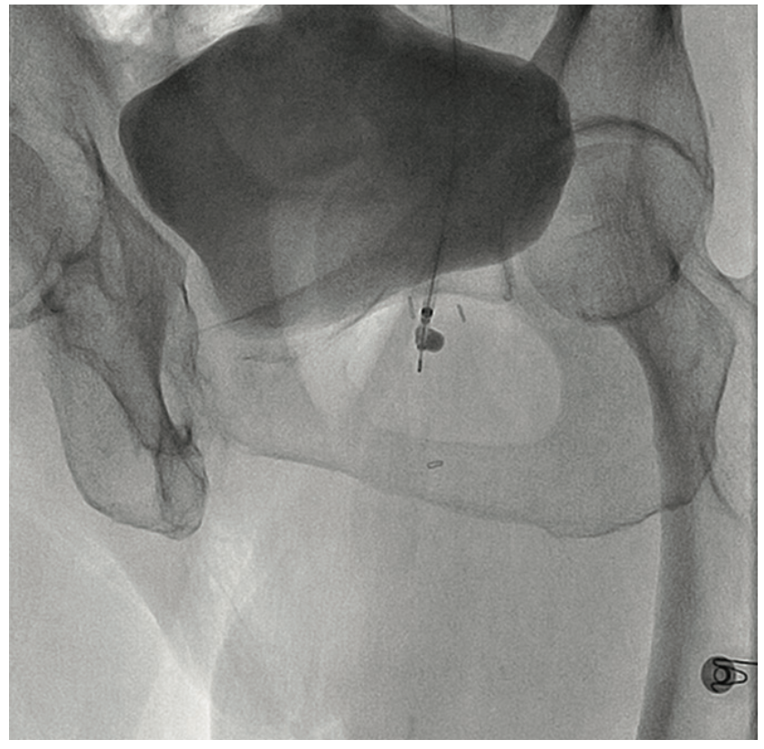 Heuser Fem-Pop Graft Failure Figure 14