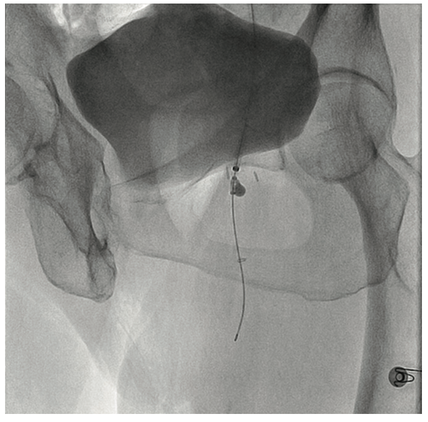 Heuser Fem-Pop Graft Failure Figure 15