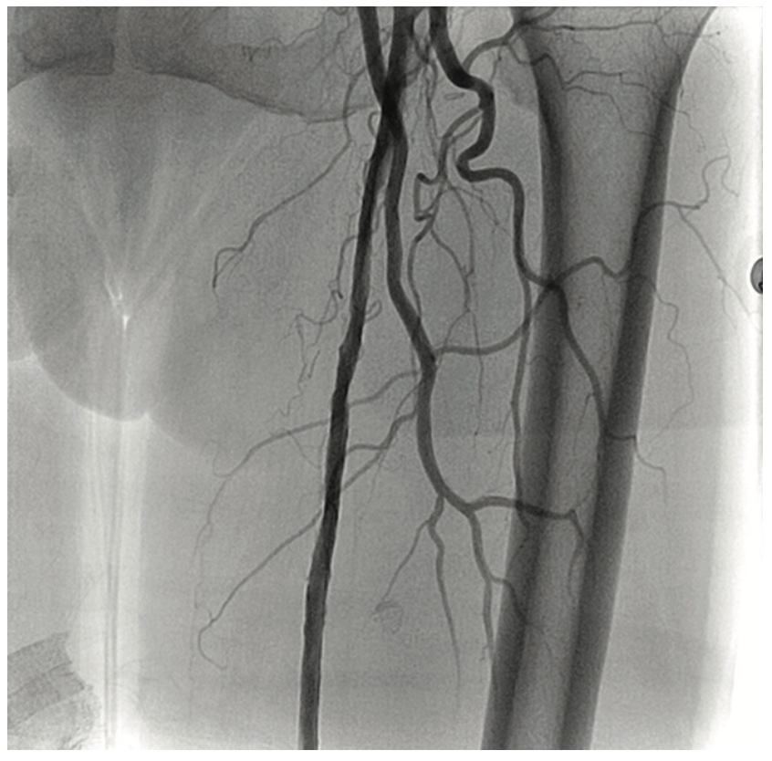 Heuser Fem-Pop Graft Failure Figure 16