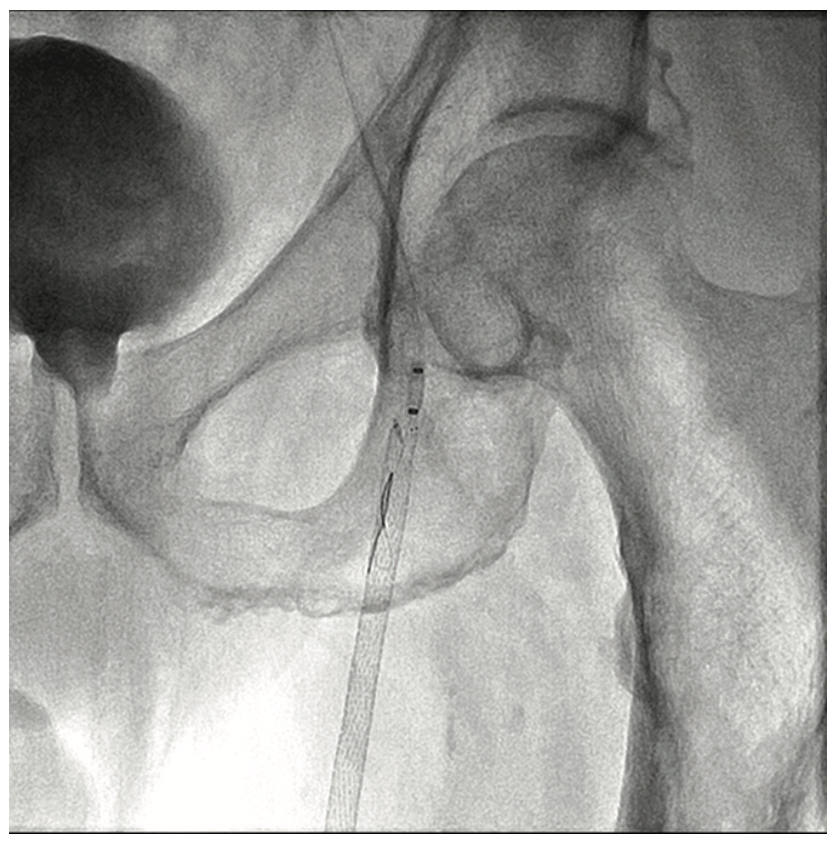 Heuser Fem-Pop Graft Failure Figure 4