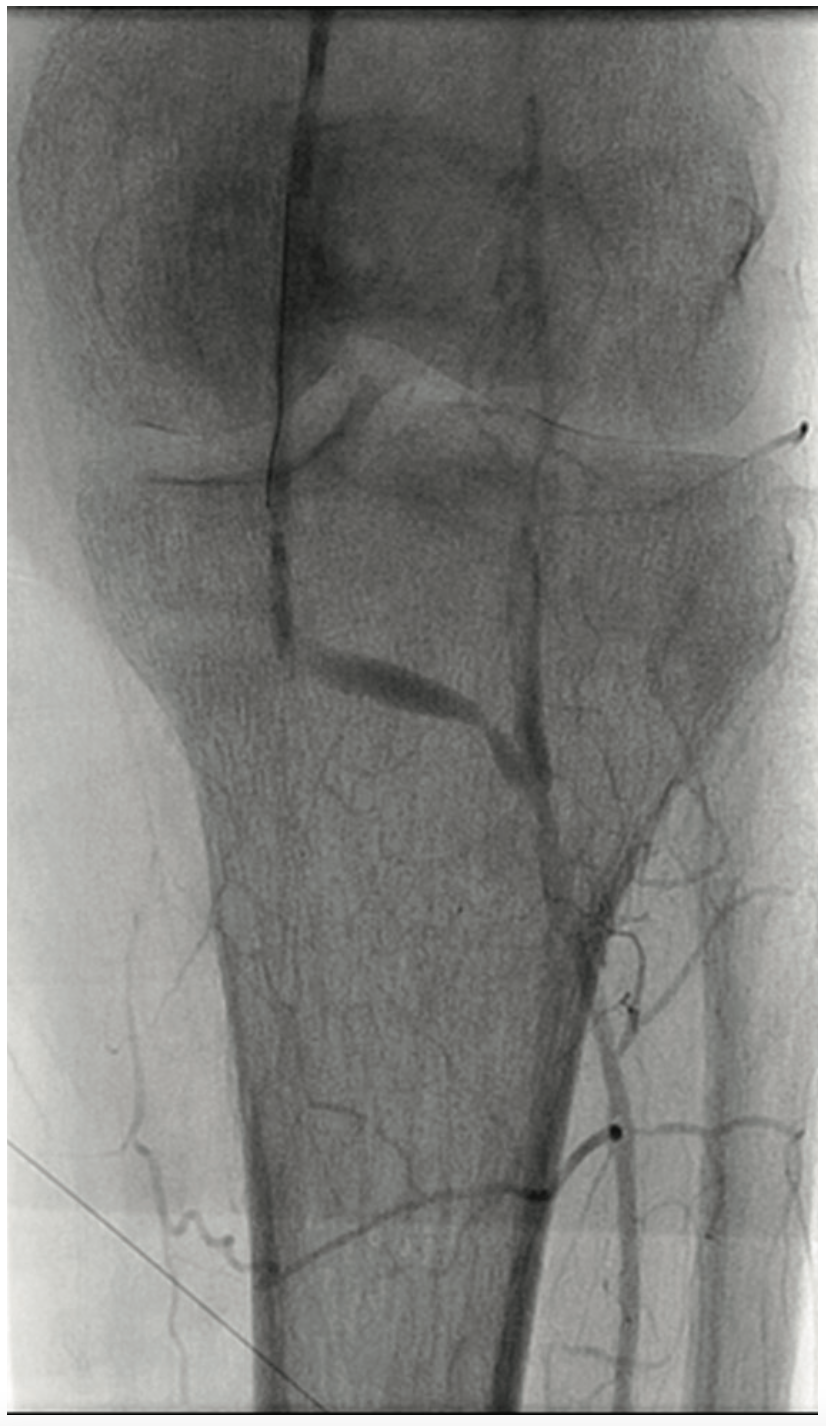 Heuser Fem-Pop Graft Failure Figure 5