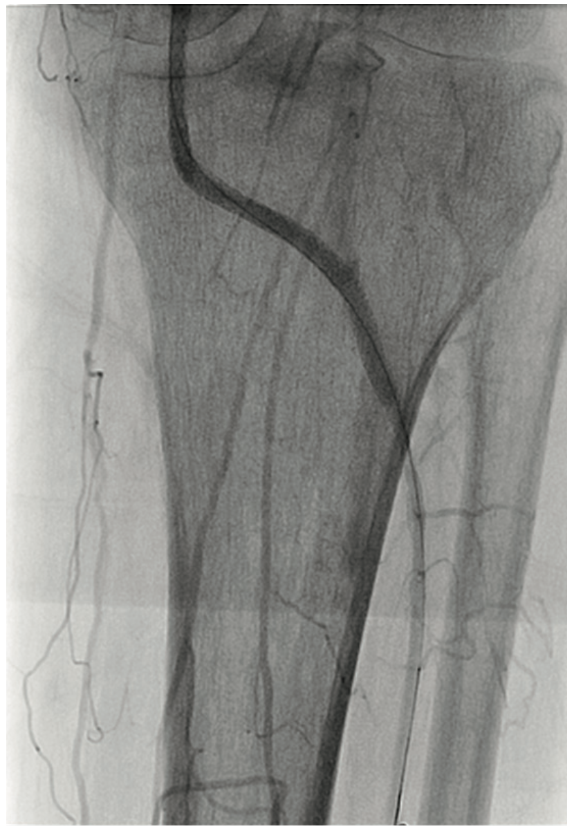 Heuser Fem-Pop Graft Failure Figure 7