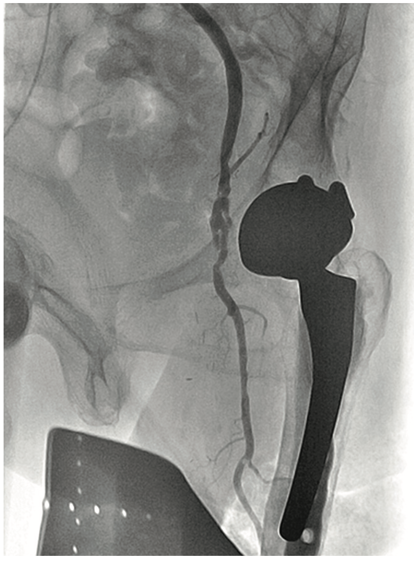 Heuser Fem-Pop Graft Failure Figure 8