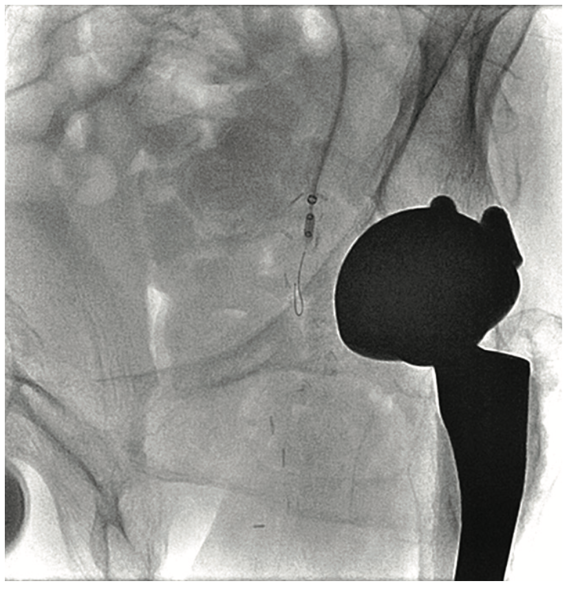 Heuser Fem-Pop Graft Failure Figure 9