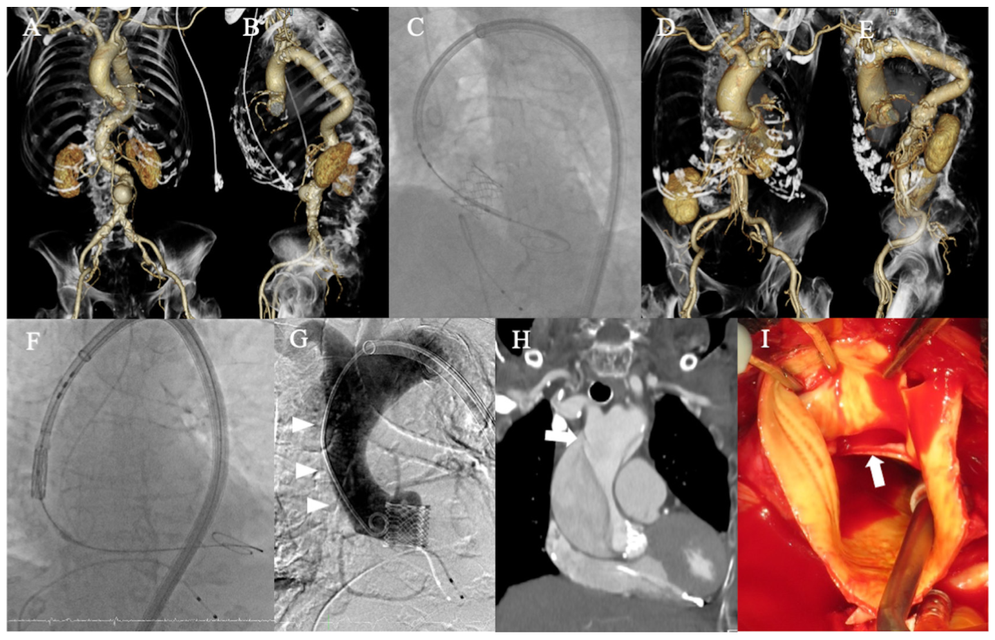 Higuchi TAVR Figure 1