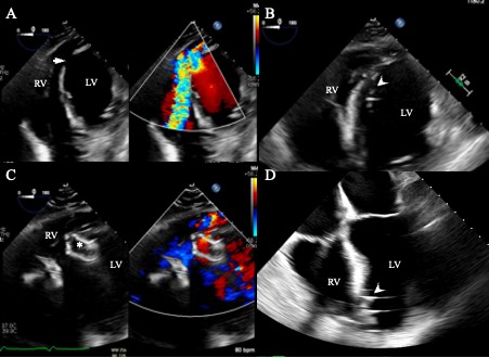 Figure 1. Transesopheal echocardiographic views 