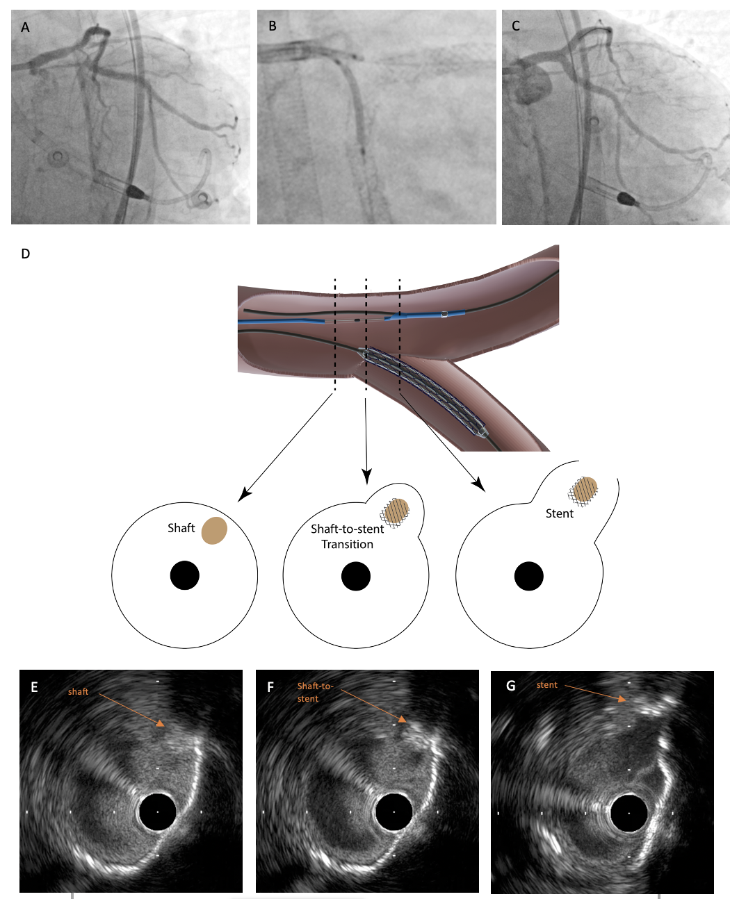 Figure 1. Real-time IVUS guided minimal crush. 