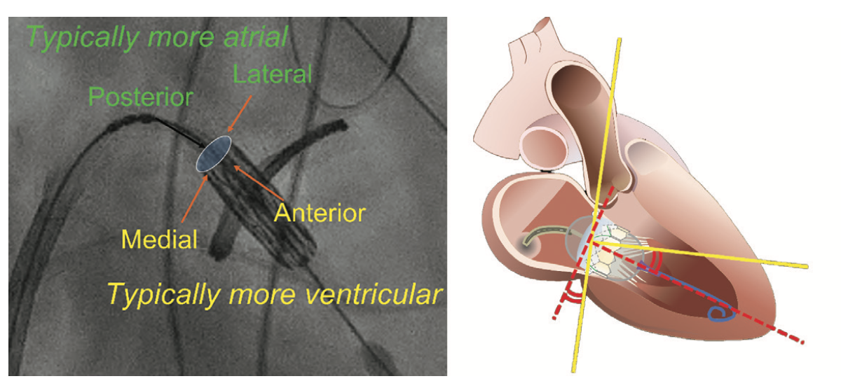 IAGS Greenbaum 5.2 TMVR Figure 3