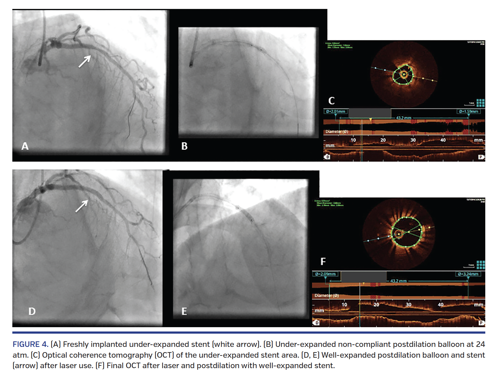 FIGURE 4. (A) Freshly implanted under-expanded stent.png