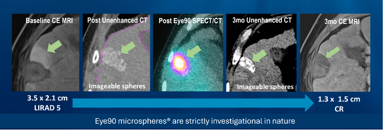 Representative images from a subject in this study showing complete response