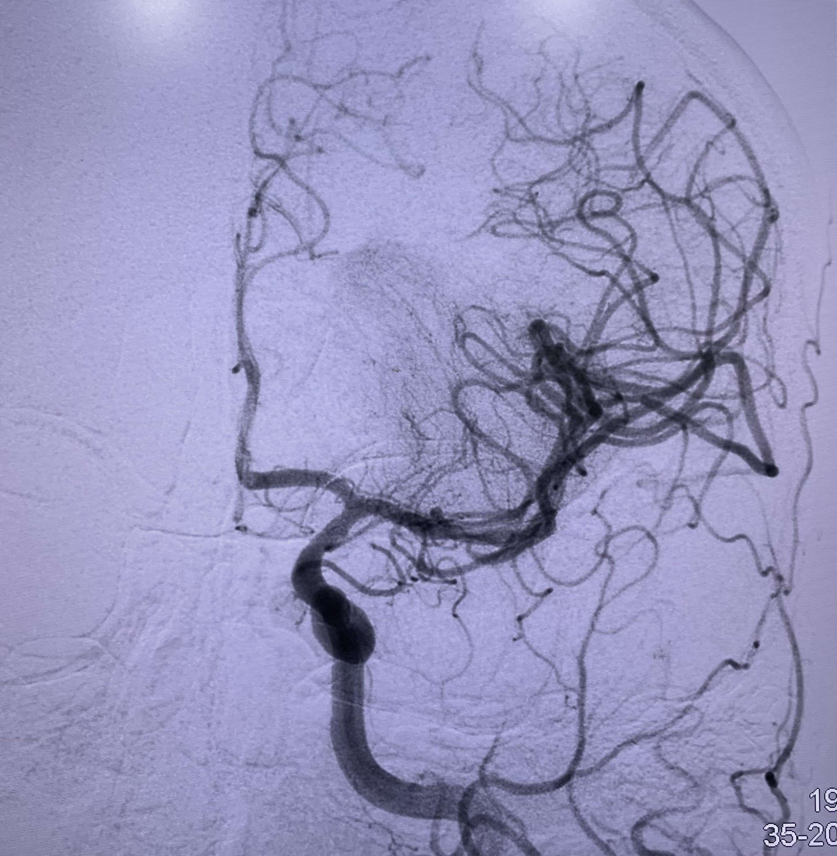Figure 4. Digital subtraction angiography image of the left internal carotid artery after aspiration thrombectomy showing complete revascularisation of the left middle cerebral artery.