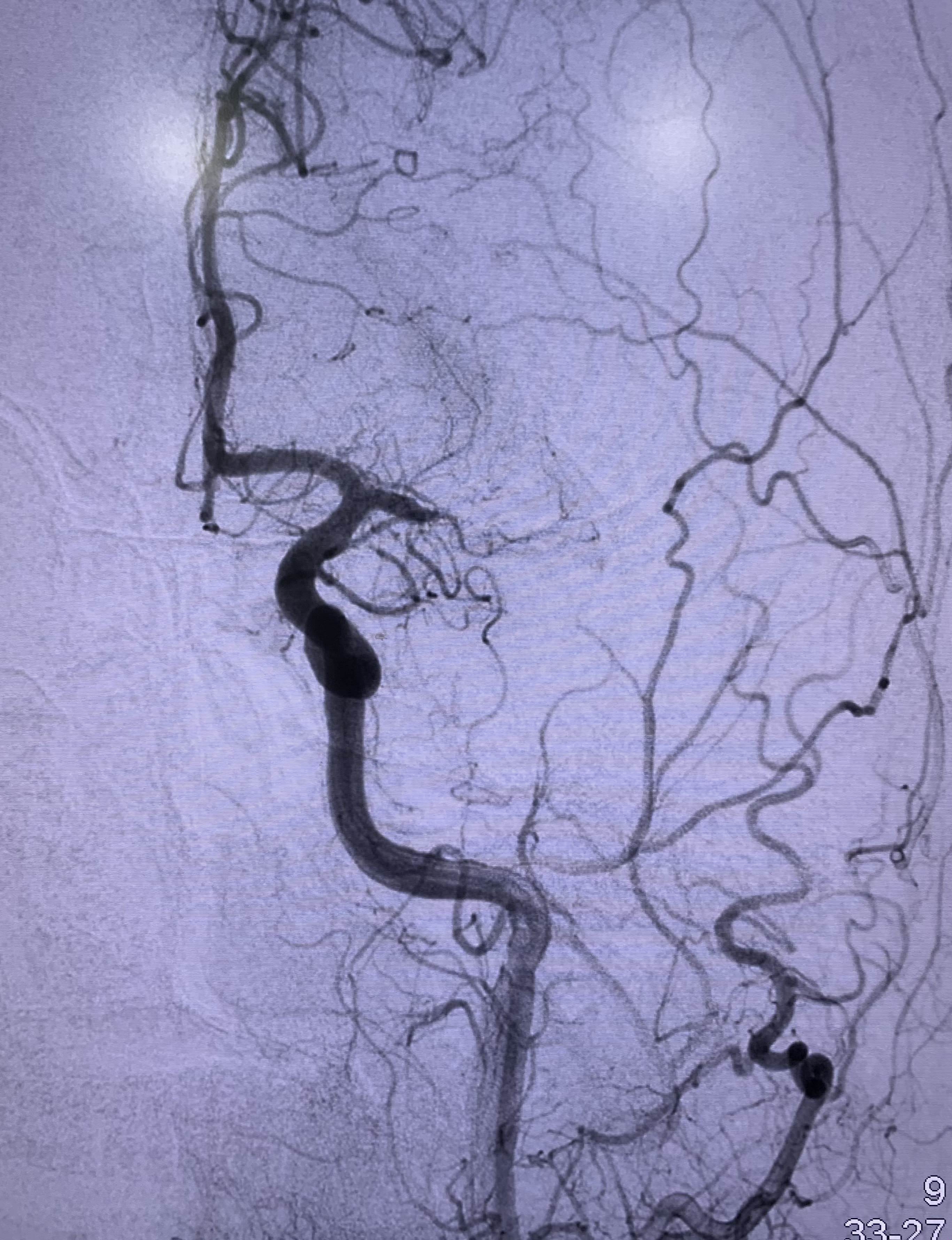 Figure 3. Digital subtraction angiography image of the left carotid injection showing occlusion of the left M1 middle cerebral artery.