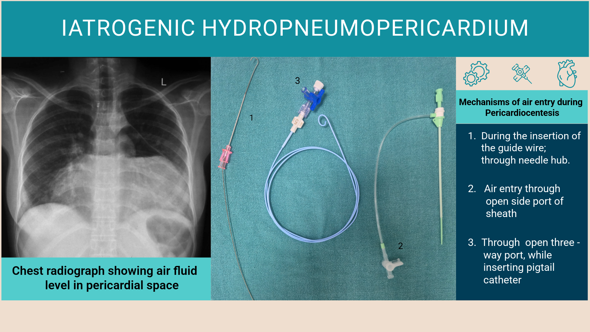 Figure 1. Iatrogenic hydropnuemopericardium