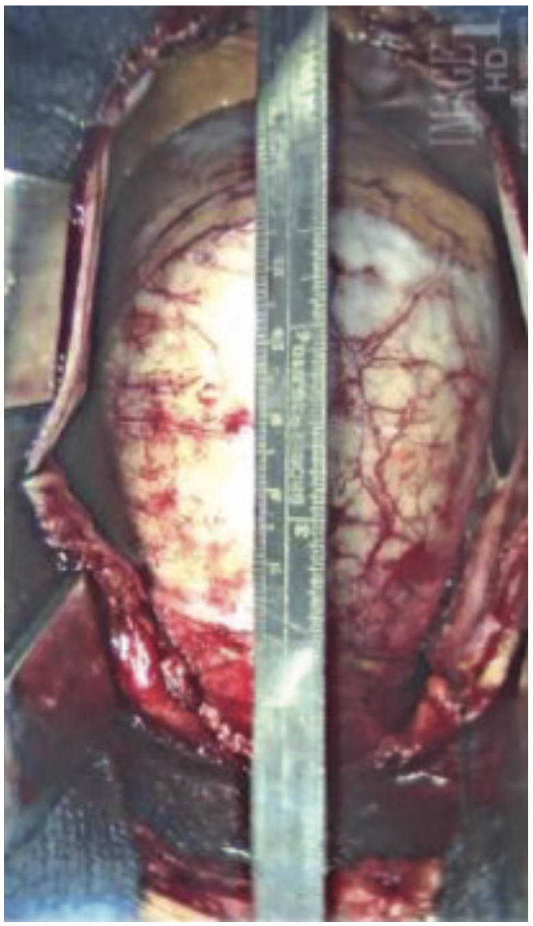 Ibrahim Aneurysm Figure 10