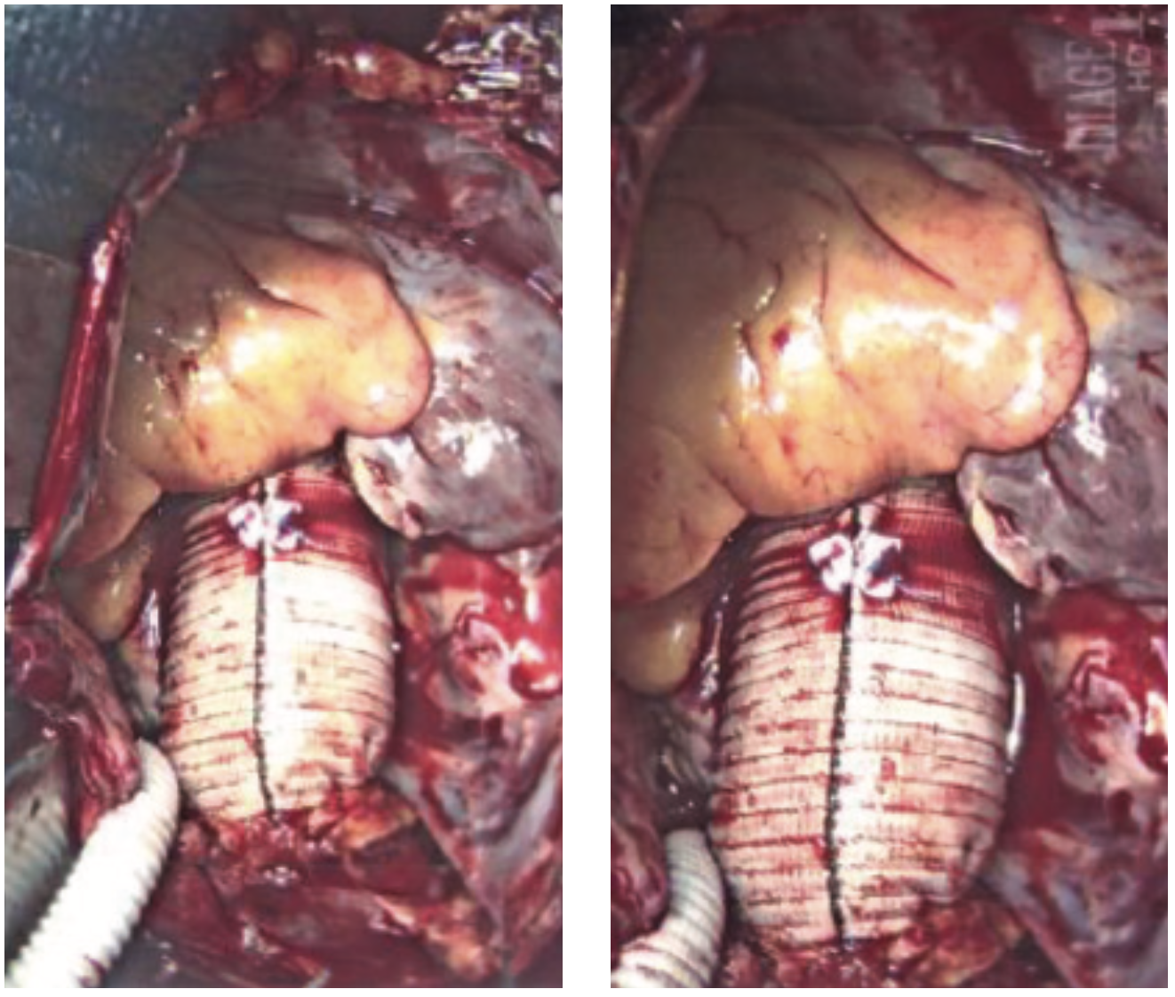 Ibrahim Aneurysm Figure 11