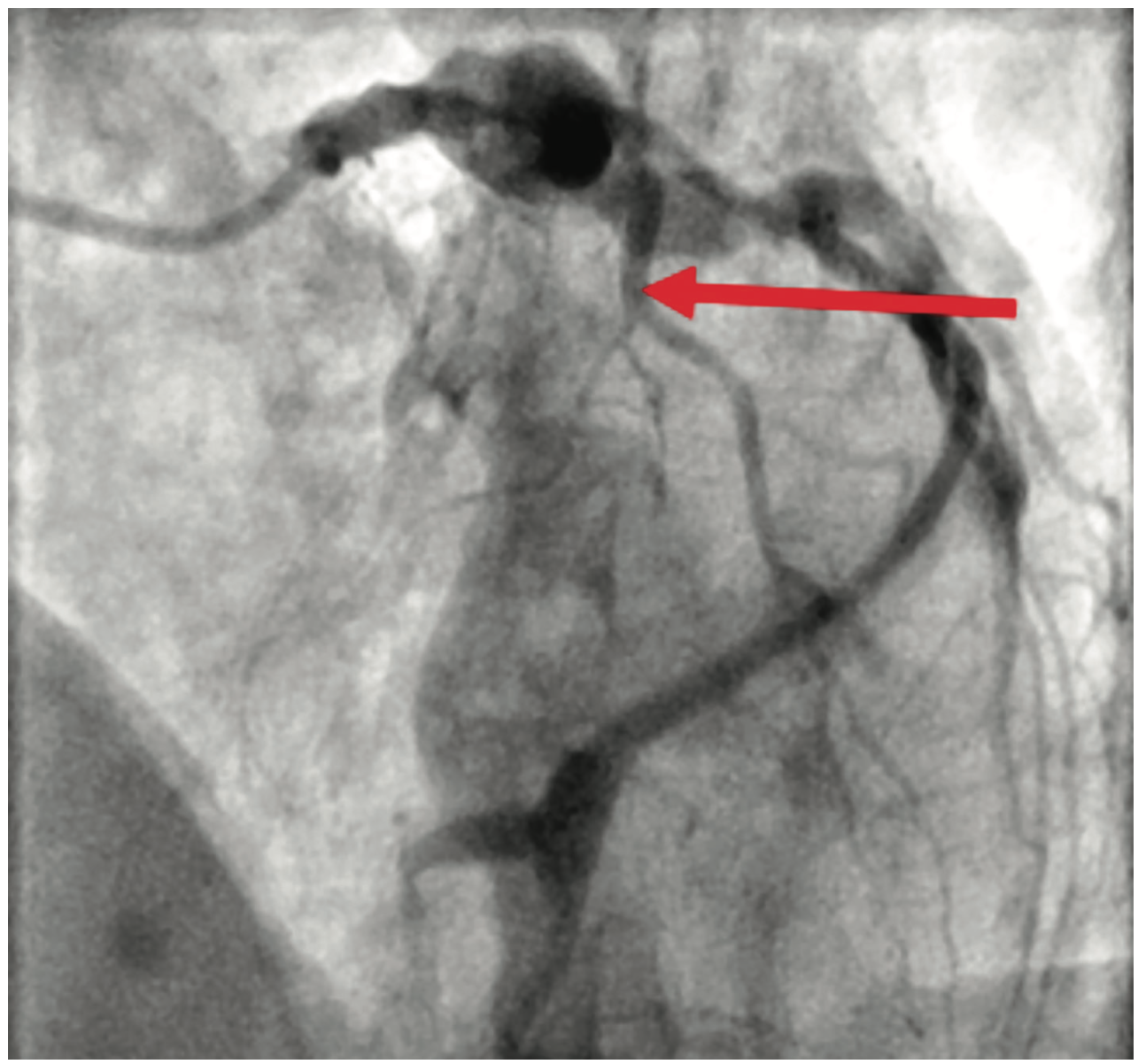 Ibrahim Aneurysm Figure 1