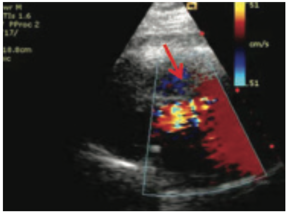 Ibrahim Aneurysm Figure 2