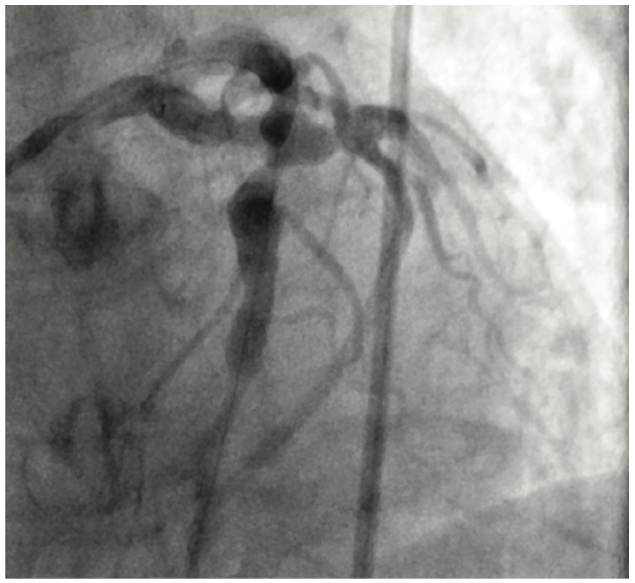 Ibrahim Aneurysm Figure 2