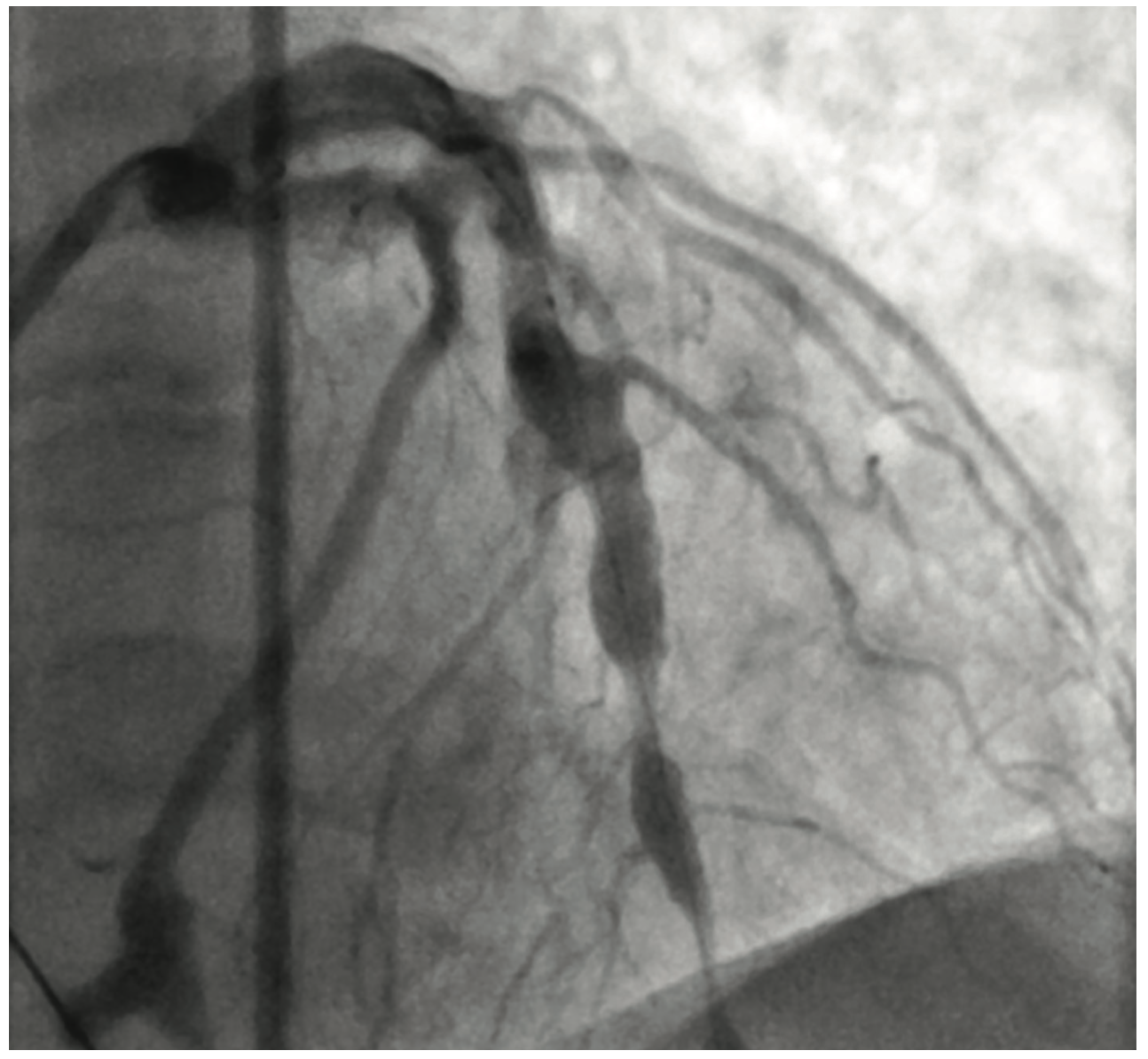 Ibrahim Aneurysm Figure 3