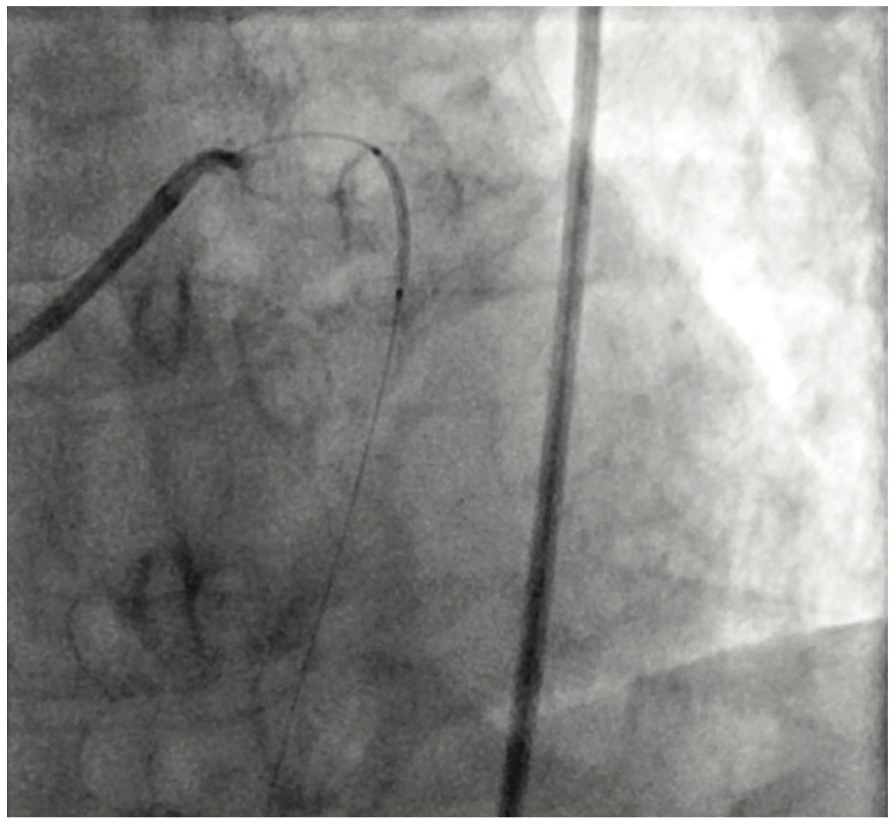 Ibrahim Aneurysm Figure 4