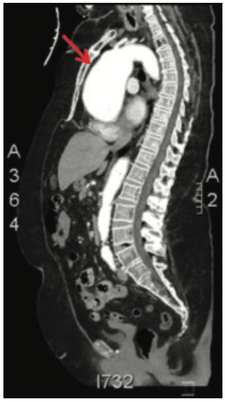 Ibrahim Aneurysm Figure 5