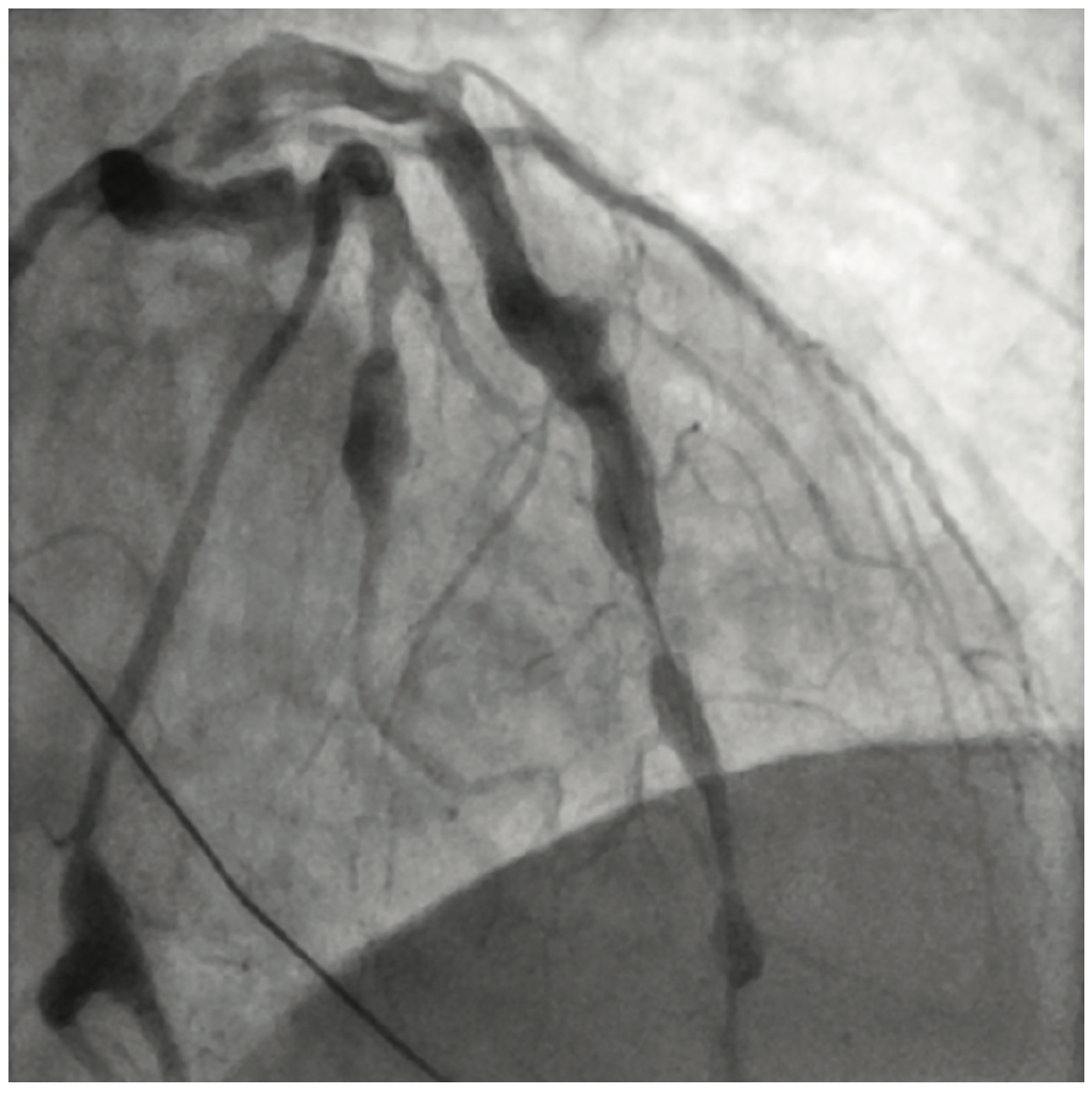 Ibrahim Aneurysm Figure 5